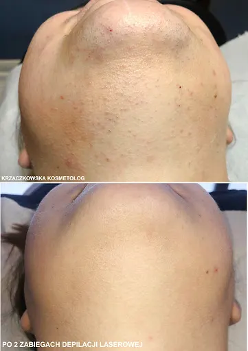 Depilacja laserowa - Kosmetolog Karolina Krzaczkowska